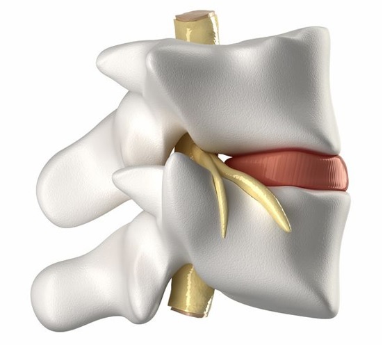 Non-Surgical Treatment for Herniated Discs